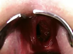 KINKYNIKY DOUBLE ANAL FISTING PROLAPSE XO SPECULUM GAPE